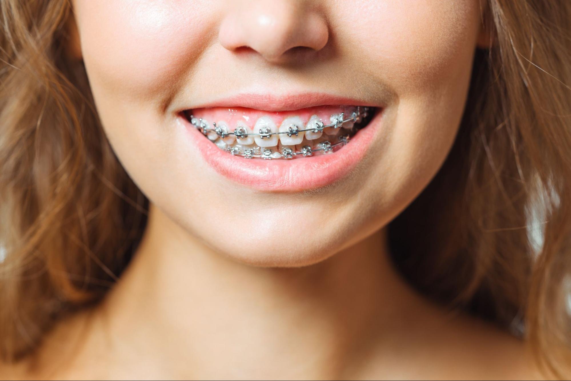 5 Tips for Braces and Clear Aligners
